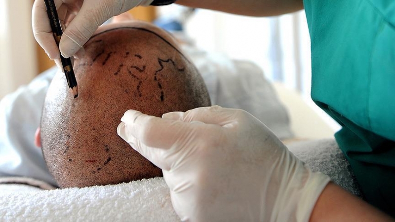 Turkije eerste keuze voor haartransplantaties in Europa